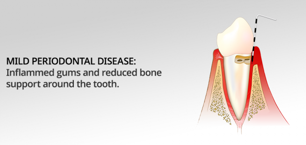 Treatments For Periodontal Disease | UK Periodontist